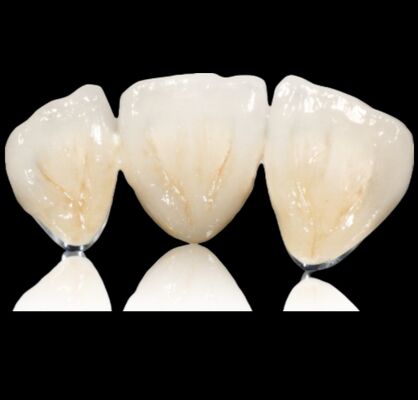 কেনা কাস্টমাইজযোগ্য সেমি মূল্যবান মুকুট বা ব্রিজ মূল্যবান খাদ মুকুট এবং ব্রিজ online manufacture