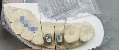 ধাতব / প্রাকৃতিক টিআই বেস ক্রাউন পোস্ট কোর টাইটানিয়াম দাঁতের জন্য মুকুট